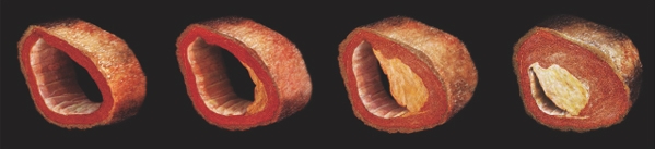 시사저널 자료사진=혈관이 좁아지고 막히는 과정
