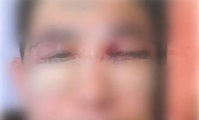 눈밑 지방 재배치 수술받은 환자 ⓒJTBC보도 캡처본