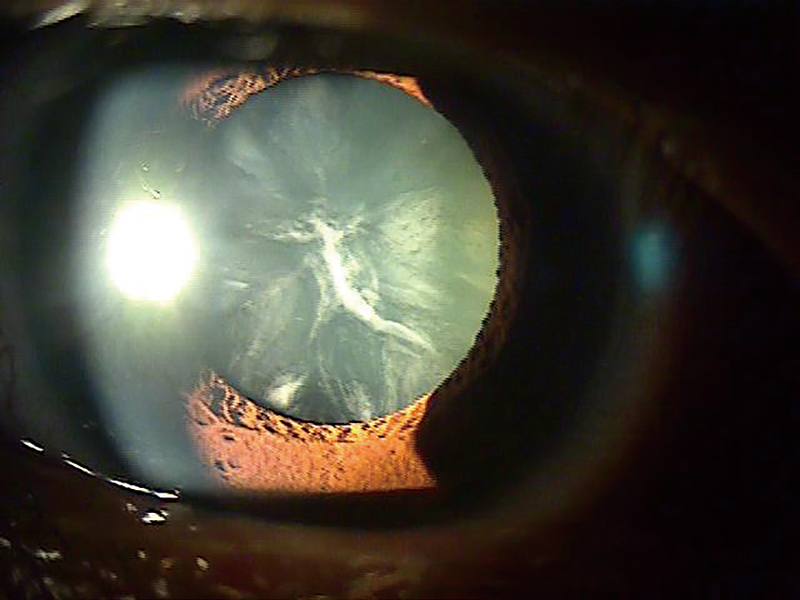 백내장 수술 전 ⓒ시사저널 사진 자료