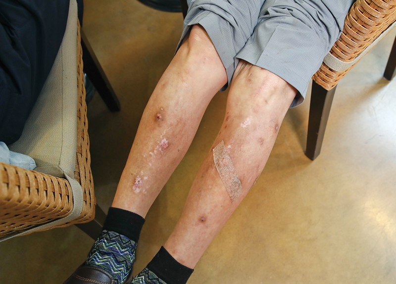 심상수씨(가명)가 8월8일 시사저널과 만나 다리의 상처를 보이고 있다. ⓒ시사저널 임준선