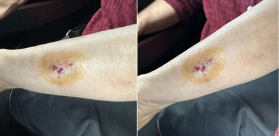 4일 경찰에 따르면, 부산 부산진경찰서는 상해 등 혐의를 받는 20대 여성 A씨를 불구속 입건해 수사 중이다. 지난 2일 오전 8시20분쯤 부산진구 가야역 일대를 운행 중이던 시내버스 안에서 옆좌석에 앉았던 아동 B(4)군을 때리고 60대 여성 C씨를 깨물어 상해를 입힌 혐의와 관련해서다. 사진은 피해자의 가족이라 밝힌 네티즌이 앞서 한 온라인 커뮤니에 쓴 피해 호소글에 첨부된 피해자의 사진 ⓒ네이트판 캡처