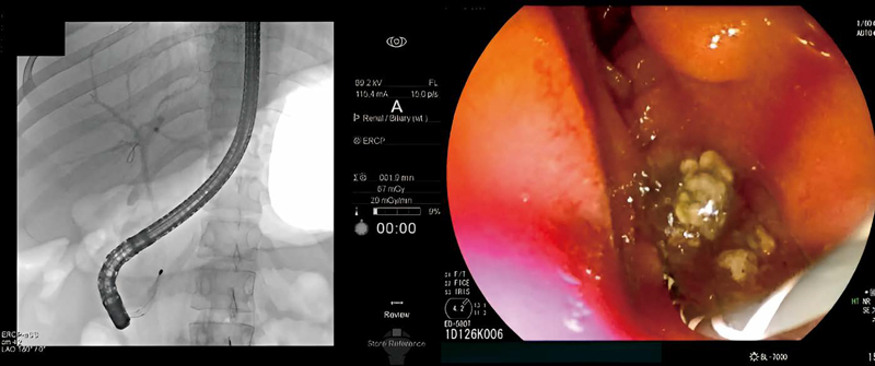 ERCP 시술을 통해 담관 담석을 제거하는 모습 ⓒ한림대동탄성심병원